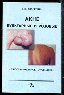 Адаскевич В.П. - Акне вульгарные и розовые - 2005 - фото 225180